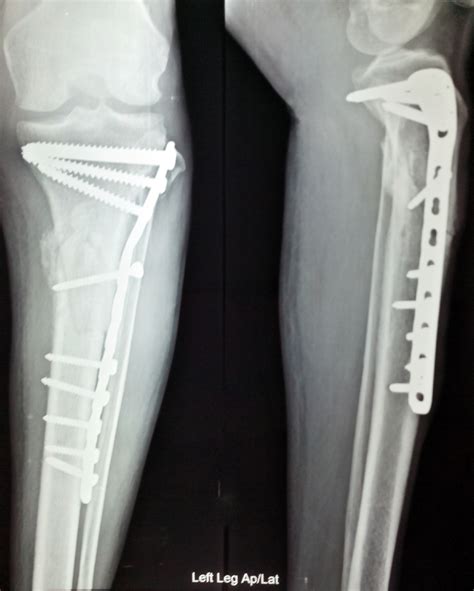 Fracture fixation; Skeletal Fixation