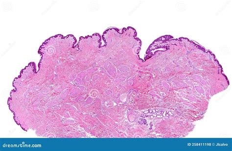 Human Breast Gland Adenosis Excretory Ducts Stock Photography