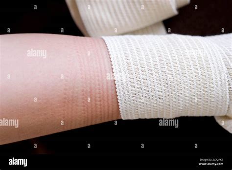 A Pattern On The Skin From A Medical Bandage Removed The Elastic