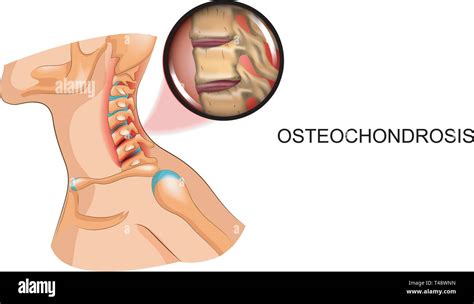 The Disc Disease In Neck