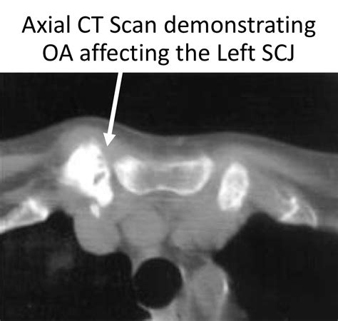 Fig 15 Scj Oa Ct Cambridge Shoulder