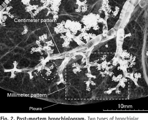 Figure 2 From Tree In Bud Pattern Of Pulmonary Tuberculosis On Thin Section Ct Pathological