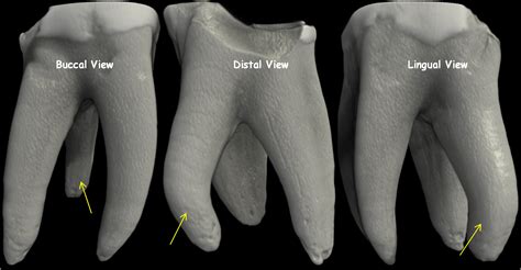 The Root Canal Anatomy Project: February 2012