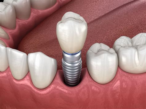 The Ultimate Guide To Dental Implants Process And Timelines