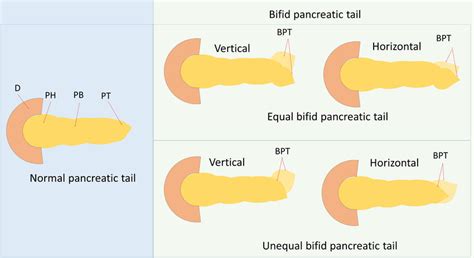 Classification Of The Bifid Pancreatic Tail D Duodenum Ph