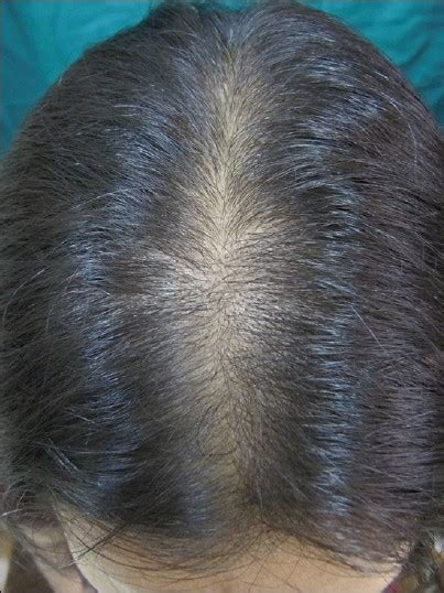 Female pattern hair loss - Indian Journal of Dermatology, Venereology ...