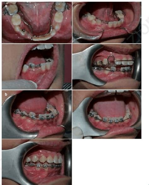 A Pictures Of The Different Phases Of The Orthodontic Treatment B