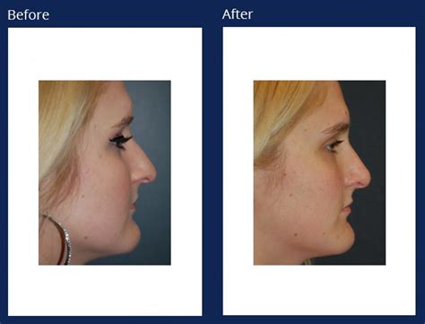 Nose Rhinoplasty Holzapfel Lied Plastic Surgery