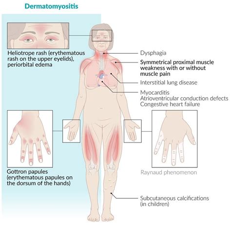 Dermatomyositis | Medical Junction