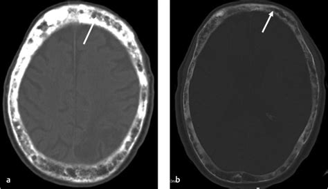 9 Hyperostosis Frontalis Interna Radiology Key