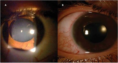 Preoperative A And Postoperative B Slitlamp Photographs Of The