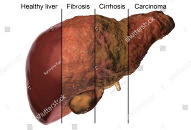 Enhanced Liver Fibrosis Modern Wellness Diagnostic Services Blog