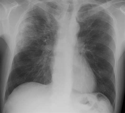 A Review Of Clinical And Imaging Findings In Eosinophilic Lung