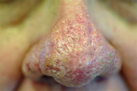 Rhinophyma (Bulbous Nose) Treatment Case 1781 - GK Dermatology, PC