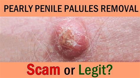 Pearly Penile Papules Removal Review Scam Or Legit Youtube