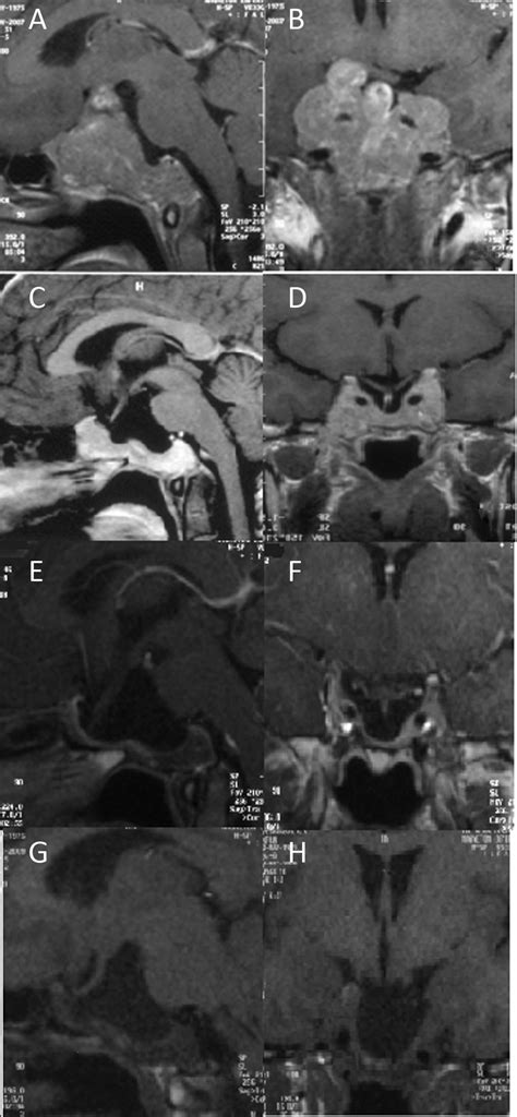 The Dynamics Of A Giant Prolactinoma In A 32 Year Old Woman See The