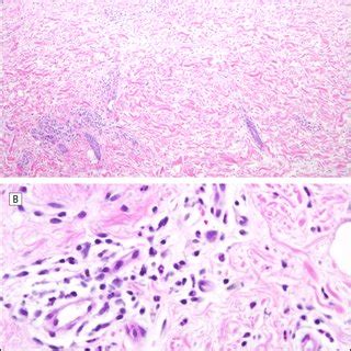 Histopathological Findings In Patient A Low Power View Showing A