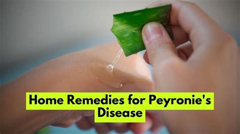 Home Remedies For Peyronies Disease Comprehensive Guide