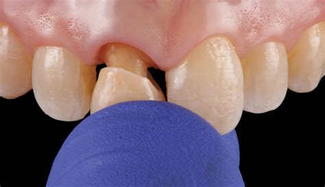 How Dental Cement Works To Hold Crowns In Place Mercer 48 OFF