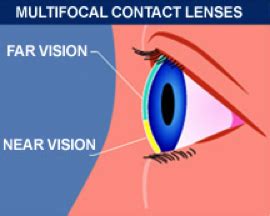 Bifocal Contact Lenses | Optometrist in Midland