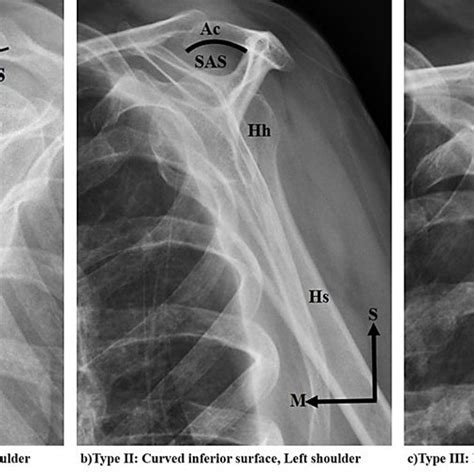 Acromial Types As Proposed By Bigliani Et Al 1986 A Type I Flat