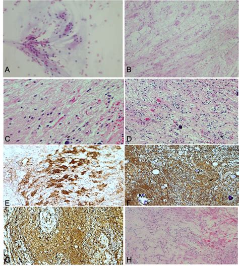 Histopathological And Immunohistochemical Findings Of Rosette Forming