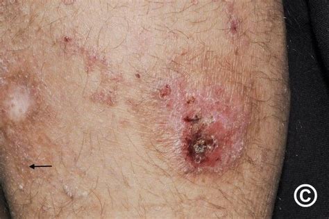 Mycosis Fungoides Pictures Symptoms Treatment And More Off