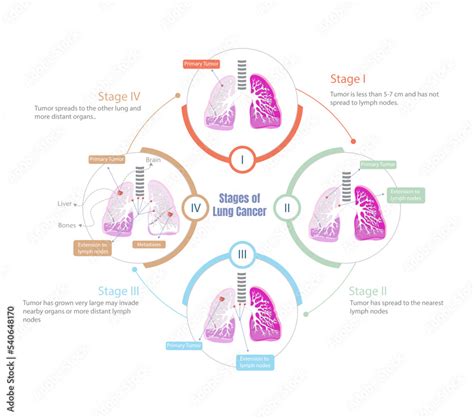 Stages of lung cancer. Process of how it progresses in all its stages ...