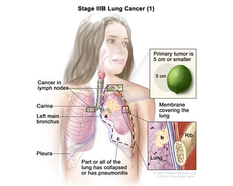 Non-Small Cell Lung Cancer Treatment (PDQ®) - NCI