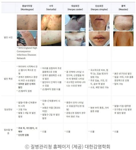 엠폭스원숭이 두창 감염병 병원체 잠복기 증상 전파경로 치명률 검사 치료 백신 등 Tmi 정보 Feat 감염병