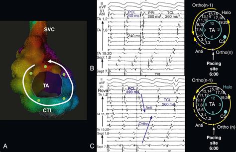 Typical And Atypical Atrial Flutter Mapping And Ablation Clinical Tree