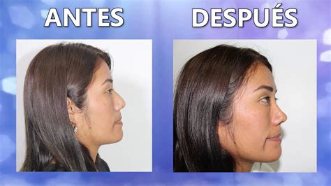 RinoplastÍa Cerrada 👃 Otro Caso Satisfecho 🤩 Dr Percy Nevado AlbÁn