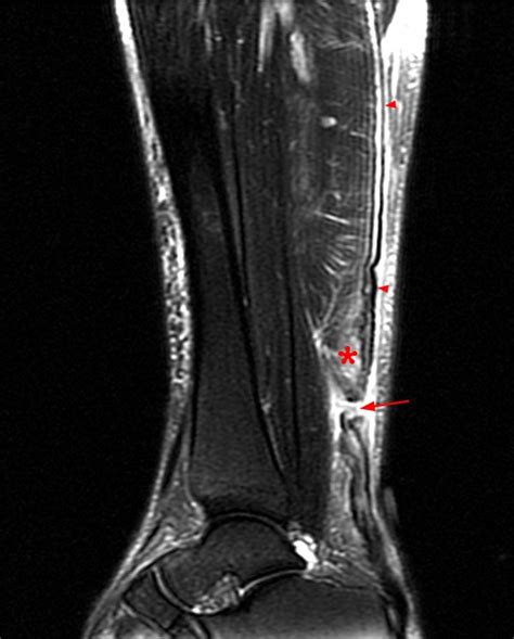 Achilles Tendon Pathology - Radsource