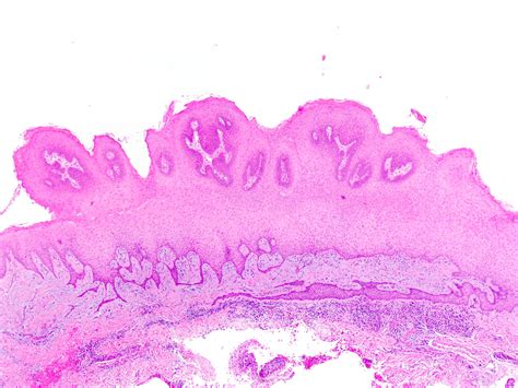 Papillomatosis Histology