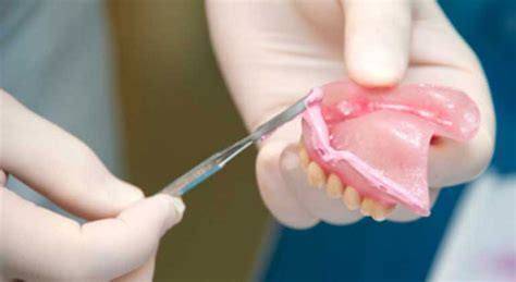 Denture Reline Cost And Procedure For Hard And Soft Relines