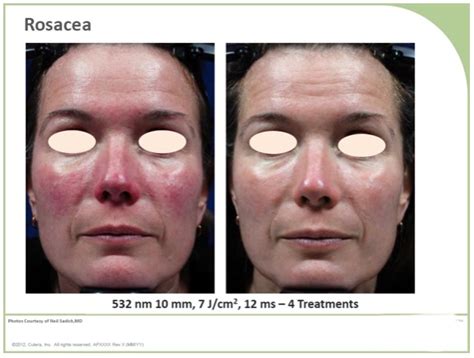 Laser Naczyniowy Chirurgia I Dermatologia Estetyczna Dzieci I