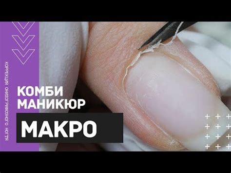 МАКРО комби маникюр 🔍Коррекция КЛЮЮЩЕГО ногтя акригелем 💅 ...