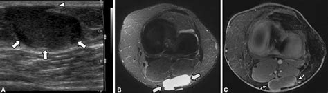 A 48-year-old female with mass ( arrows ) in the popliteal fossa ...