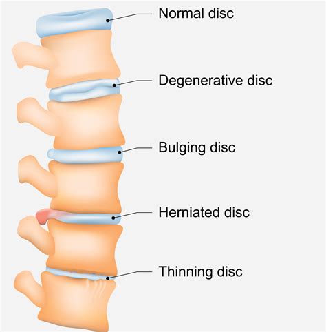 Lumbar Spine Pain: Symptoms, Causes, and Treatments | Regenexx® at New ...