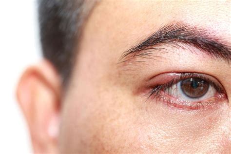 The Most Common Eye Conditions And Diseases