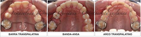 ¿quÉ Son Los Mantenedores De Espacio Clínica Dental Pico Blanco