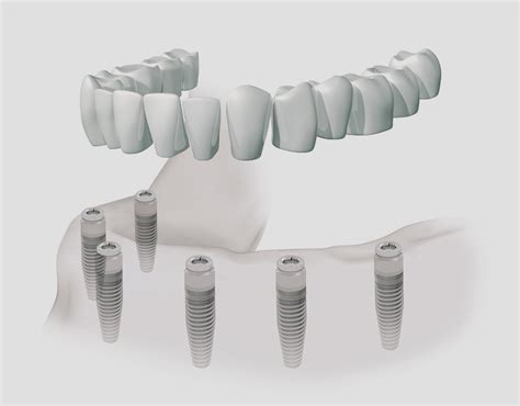 Implantes dentales en Burgos Isabel Pérez Perreau de Pinninck