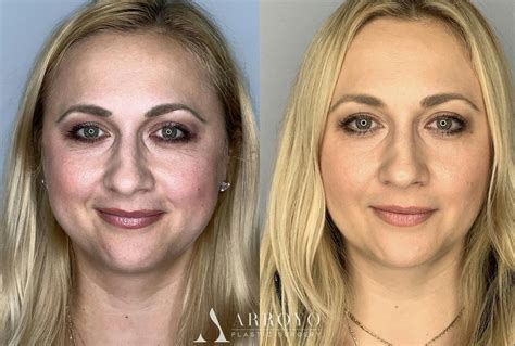 Buccal Fat Removal Before And After Photos Arroyo Plastic Surgery