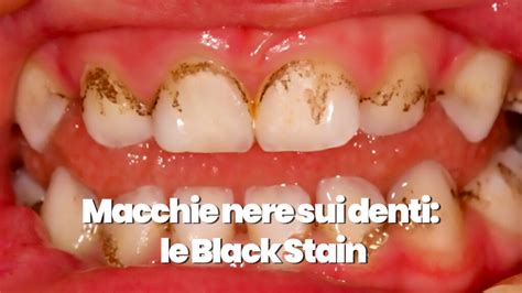 Macchie Nere Sui Denti Come Liberarsi Delle Black Stain