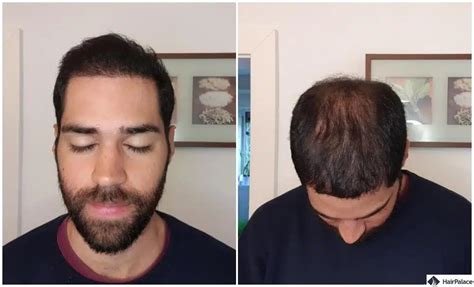 Ricrescita Dopo Trapianto Di Capelli