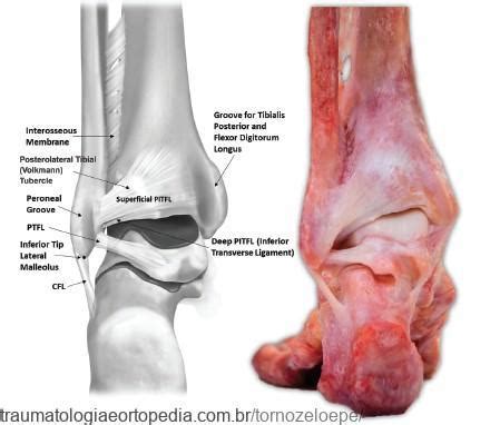 Lesão Da Sindesmose Traumatologia E Ortopedia