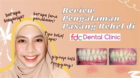 Review Pengalaman Dan Biaya Pasang Behel Sampai Lepas Behel Di FDC