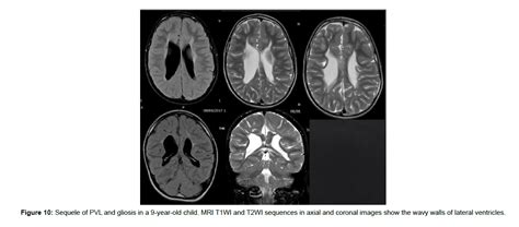 Journal Of Radiology Hypoxic Ischemic Encephalopathy Mri Findings And Patterns Review Revisited