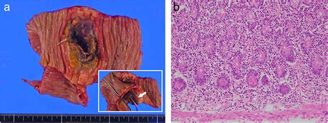 A Rare Cause Of Jejunal Perforation Monomorphic Epitheliotropic