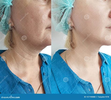 Woman Neck Wrinkles Facelift before after Correction Treatment Removal ...